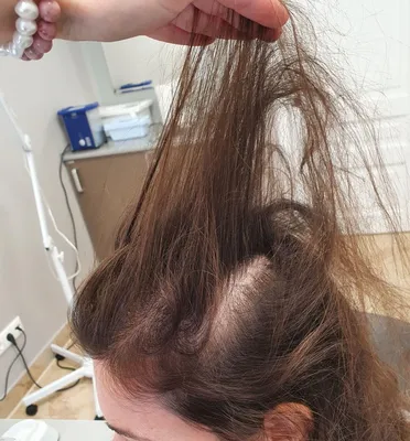 Выпадение волос у подростков – как лечить выпадение волос в подростковом  возрасте?
