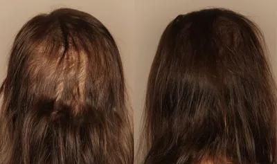 Выпадение волос после ковида – реакция организма на болезнь | ВКонтакте