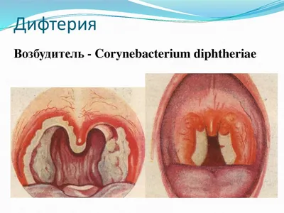 Дифтерия: причины, симптомы, лечение и профилактика | ОБУ \"Центр помощи  семье и детям \"Большая Медведица\" филиал N1 Кризисный центр помощи семье и  детям