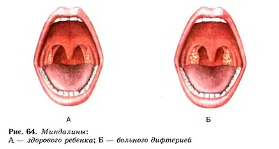 СОВРЕМЕННОЕ СОСТОЯНИЕ ПРОБЛЕМЫ ДИФТЕРИЙНОЙ ИНФЕКЦИИ. Ч. 1 – тема научной  статьи по клинической медицине читайте бесплатно текст  научно-исследовательской работы в электронной библиотеке КиберЛенинка