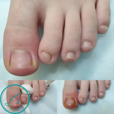 Лечение и удаление вросшего ногтя в Перми без боли по доступной цене |  Услуги подолога в Перми