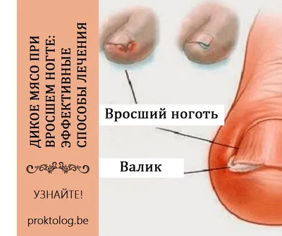 Удаление вросшего ногтя в Москве|Стоимость операции в клинике|удалить  вросший ноготь по низкой цене