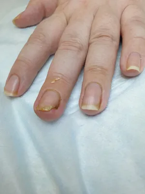 Лечение, удаление вросшего ногтя без хирургии — Центр подологии в СТОПАМЕР  СПБ
