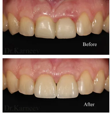 Диоксид циркония - преимущества использования в стоматологии