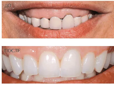 Стоимость коронок из оксида циркония в «Профи-Дент», цена протезирования в  Реутове