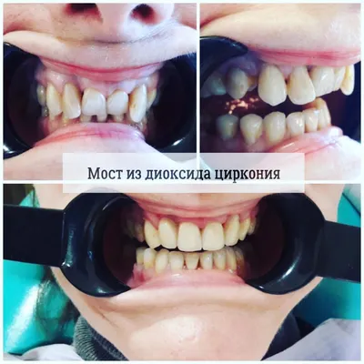 Установка моста (диоксид циркония) | Стоматология в Запорожье Dental Studio