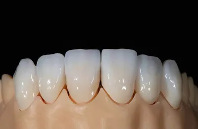 Статья о стоматологии: Диоксид циркония. Прочность и эстетика  ортопедических конструкций