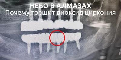 Виниры — диоксид циркония | Стоматология в Запорожье Dental Studio