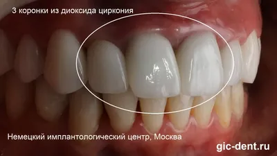 Куда лучше ставить диоксид циркония, на передние или на задние зубы? |  записки зубного детектива | Дзен