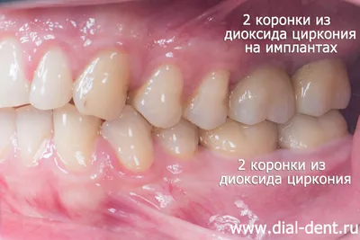 Диоксид циркония. Коронка на имплантате на жевательный зуб.
