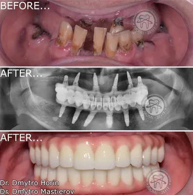 Диоксид циркония. Восстановление всех зубов. | White Crown