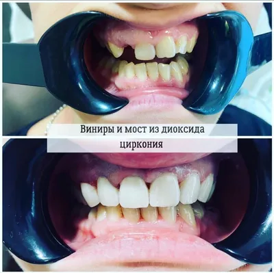 Какой зубной имплант лучше - титановый или из диоксид циркония? - Немецкий  имплантологический центр, Москва