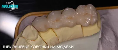 Безметалловые коронки — Акции