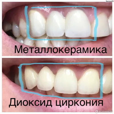 Мост и виниры — диоксид циркония | Стоматология в Запорожье Dental Studio