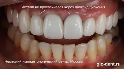 3 коронки из диоксида циркония на центральные зубы дополнили эстетику  керамики - Немецкий имплантологический центр, Москва