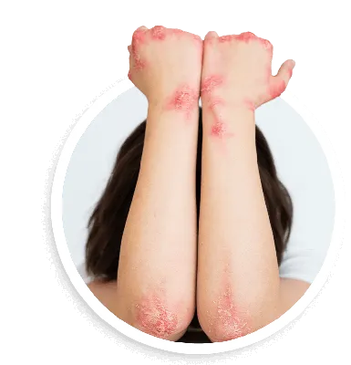 Средство для защиты восстановления кожи ЗАО \"Оберон\" Эплан - «Быстро  восстанавливает кожу при дисгидротической экземе . Фото до и после» | отзывы