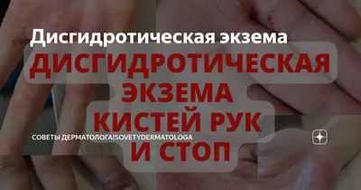 Монетовидная экзема: лечение и уход за кожей