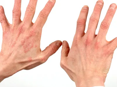 Экзема на руках: фото, лечение, причины, как выглядит на пальцах и как  навсегда избавиться от заболевания