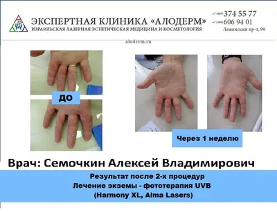 Аллергомамы - ДИСГИДРОТИЧЕСКАЯ ЭКЗЕМА (дисгидроз): вся ли сыпь это  аллергия? ⬇️ ⠀ 💥Дисгидротическая экзема – это тип экземы, поражающей руки  и ноги. Дисгидроз характеризуется появлением на боковых поверхностях пальцев  кистей и стоп,