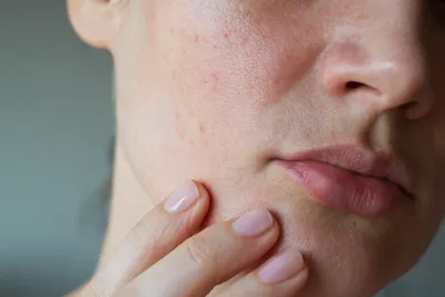 С чем связано утолщение кожи на пятках? Лечение и профилактика гиперкератоз