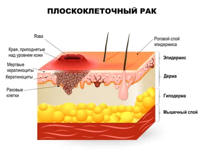Болезнь Боуэна: диагностика и лечение в Киеве. Запишитесь на консультацию к  дерматоонкологу!