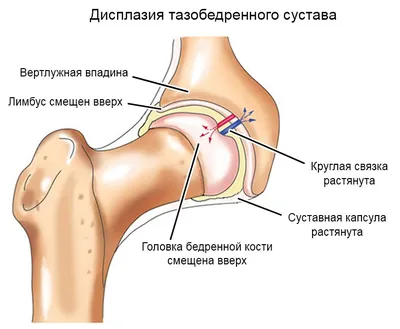 Дисплазия тазобедренных суставов: симптомы, лечение | МРТ Эксперт