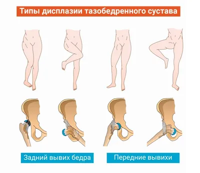 Остеопатия при дисплазии тазобедренных суставов у детей