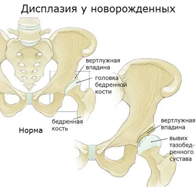 Дисплазия тазобедренного сустава у детей