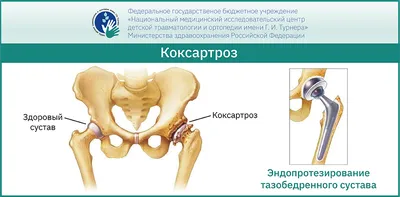 Лечение Дисплазия тазобедренного сустава и врожденный вывих бедра -  Ортопедия Руслана Сергиенко