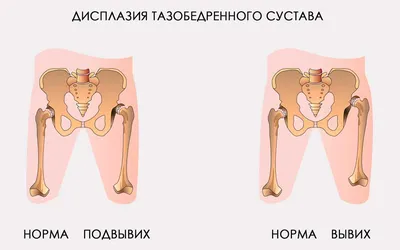 Врожденный вывих бедра и дисплазия - причины появления, симптомы  заболевания, диагностика и способы лечения