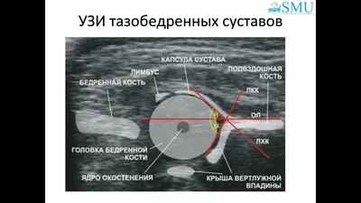 Дисплазия тазобедренных суставов у детей: чем грозит и как исправить.  Статті про здоров'я на блозі apteka24.ua