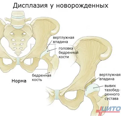 Дисплазия у новорожденного | УЗИ тазобедренных суставов | Последствия  дисплазии - YouTube