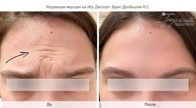 Ботокс, диспорт - Аши, косметологическая клиника