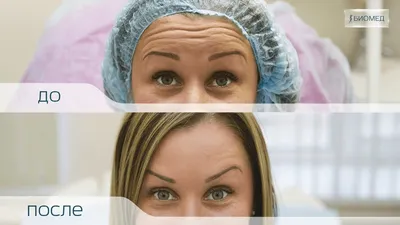 Сочетание ботокса и филлеров с пластикой - Cosmetic-clinic