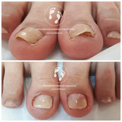 Причины появления дистрофии ногтевой пластины | Московская Клиника Подологии