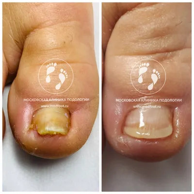 Восстановление ногтевой пластины в динамике | Московская Клиника Подологии