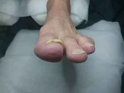 Устранение причины отслоения ногтя, образования полостей под ногтем  (онихолизис) в Центре подологии СТОПАМЕР