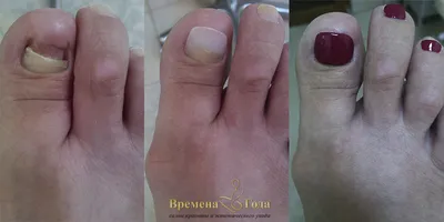 Лечение ониходистрофии ногтей в Днепре - Подо Центр Ольги Пашиной