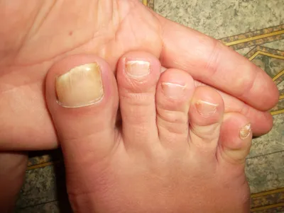 Подолог Педикюр Краснодар - 😔Дистрофия ногтя, или ониходистрофия -  изменение формы, размера и структуры ногтевой пластины. Она включает также  изменения ложа ногтя и ногтевых валиков. ☝️Ониходистрофия может быть как  самостоятельной болезнью, так