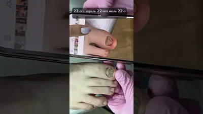 Лечение онихогрифоза ногтей в Москве в Клинике Подологии | Цены на лечение  онихогрифоза