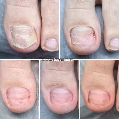 Устранение причины отслоения ногтя, образования полостей под ногтем  (онихолизис) в Центре подологии СТОПАМЕР