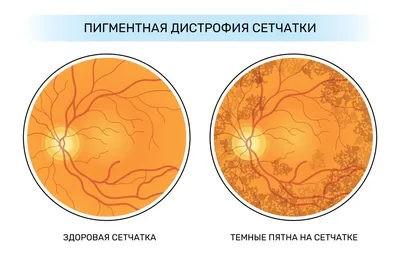 Дистрофия сетчатки глаза: что это, причины, симптомы, современные подходы к  диагностике и лечению