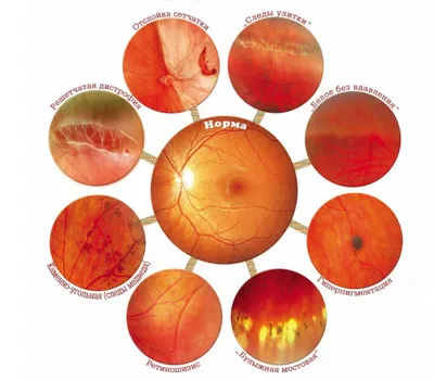 Решетчатая дистрофия сетчатки глаза - признаки, диагностика, лечение