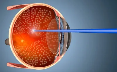 Клиника Здоровье - Сетчатка глаза: заболевания и их лечение