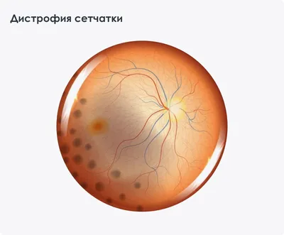 Лечение дистрофии сетчатки глаза в Санкт-Петербурге, лазерная коагуляция  сетчатки