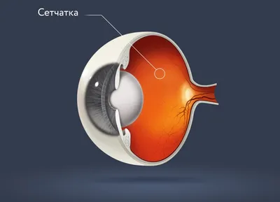 Как проявляется дистрофия сетчатки глаза - YouTube
