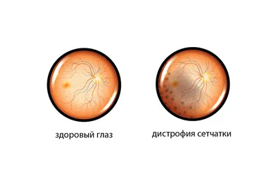 Дистрофии сетчатки глаза: как предотвратить | блог Хирургия глаза