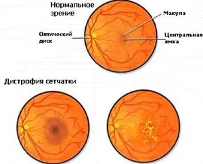 Дистрофия сетчатки глаза - признаки, причины, симптомы, лечение и  профилактика - iDoctor.kz
