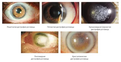 Лечение отслоения сетчатки глаза - Разрыв сетчатки, цена операции на  сетчатке | Visiobud