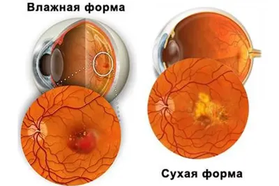 Дистрофия сетчатки глаза: симптомы, диагностика, лечение лазером